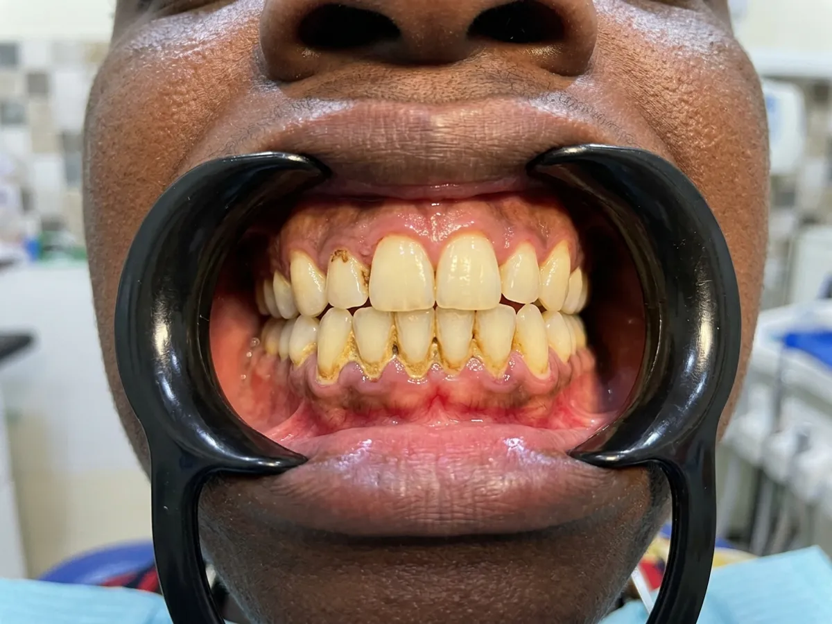 Scaling & polishing, before
